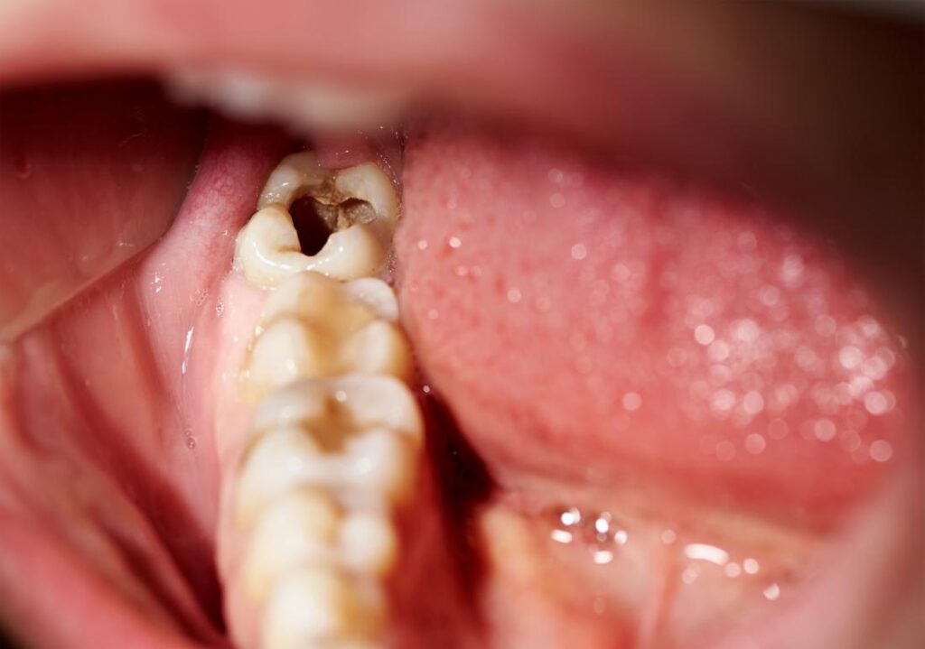 Dental Pulp Infections: Causes, Symptoms, and Treatment