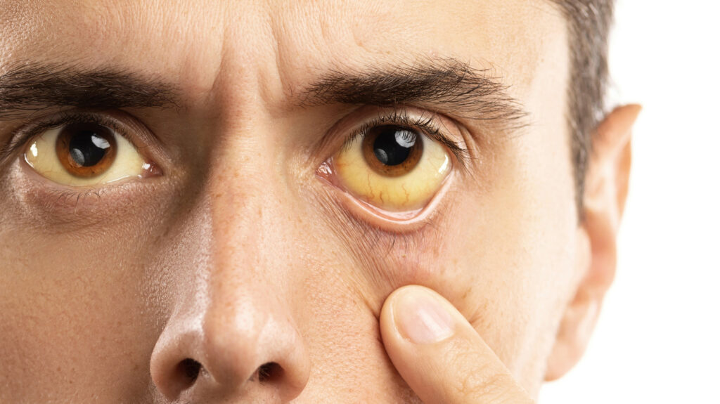 Yellow Fever: Causes, Symptoms, Prevention, and Importance of Yellow Fever Vaccination